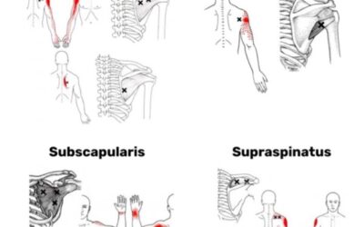 変な腕の痛み?実は肩から来ているかもしれません <関連痛>