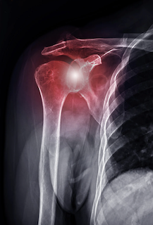 インピンジメント インピンジメント